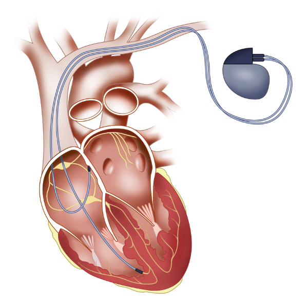 illustratie hart met pacemaker